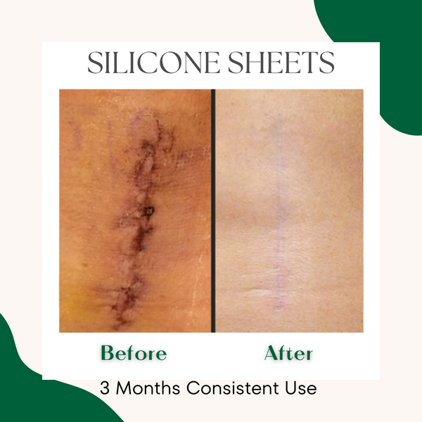 Stretch Mark, Scar, Wrinkle  Prevention & Relief Kit